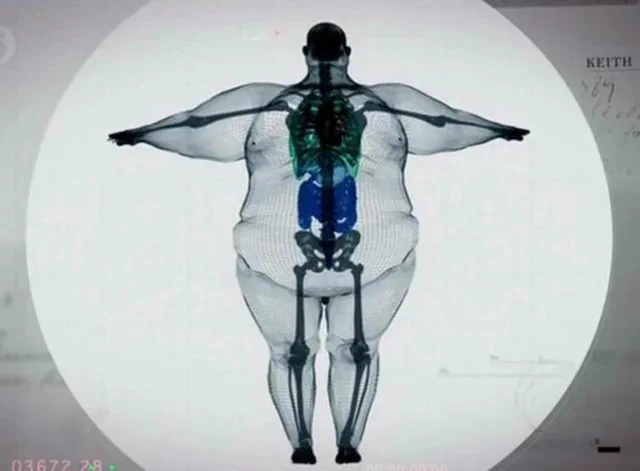 一位 300 多公斤重男子的 X 光影像
